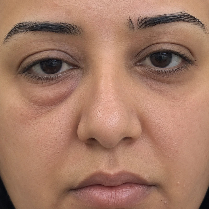 Before - Less Puffy
